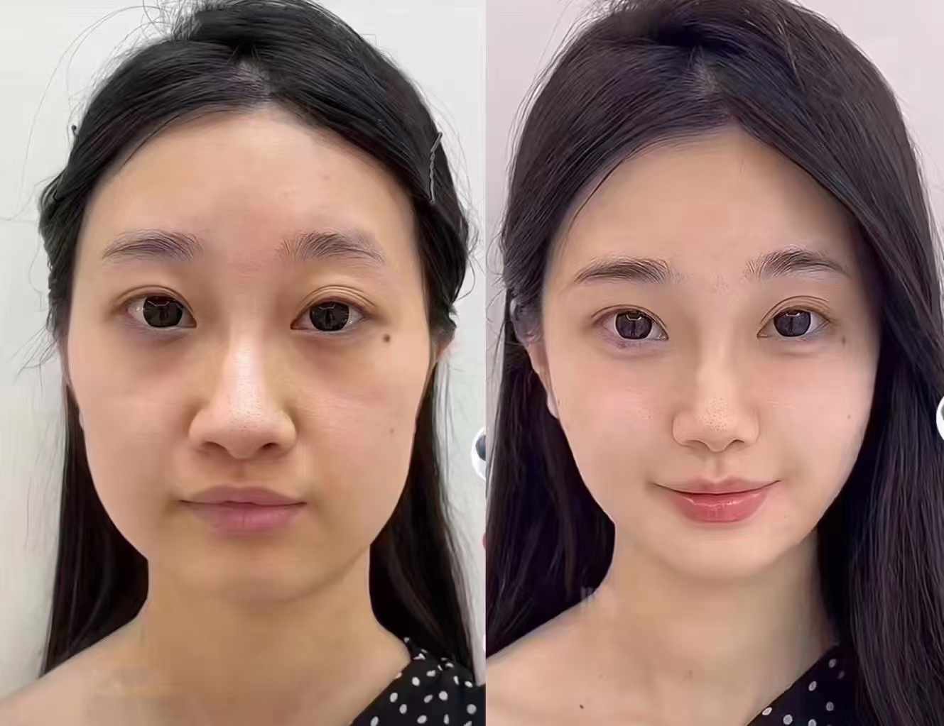 南京李啟壽的長效面部提升支架技術(shù)原理大揭秘