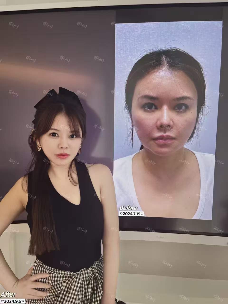 口角囊袋提升術能帶來怎樣的成效？