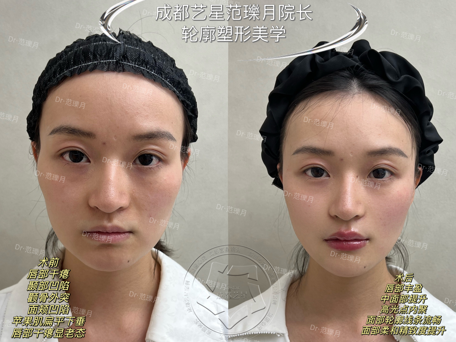 李建剛醫(yī)生在面部提升領域有哪些優(yōu)勢？