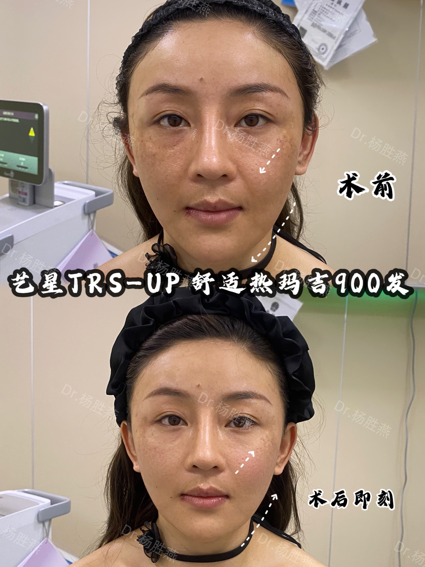 成都素美李建鋼醫(yī)生無痕筋膜提升，50000元起開啟面部持久緊致之旅！ 