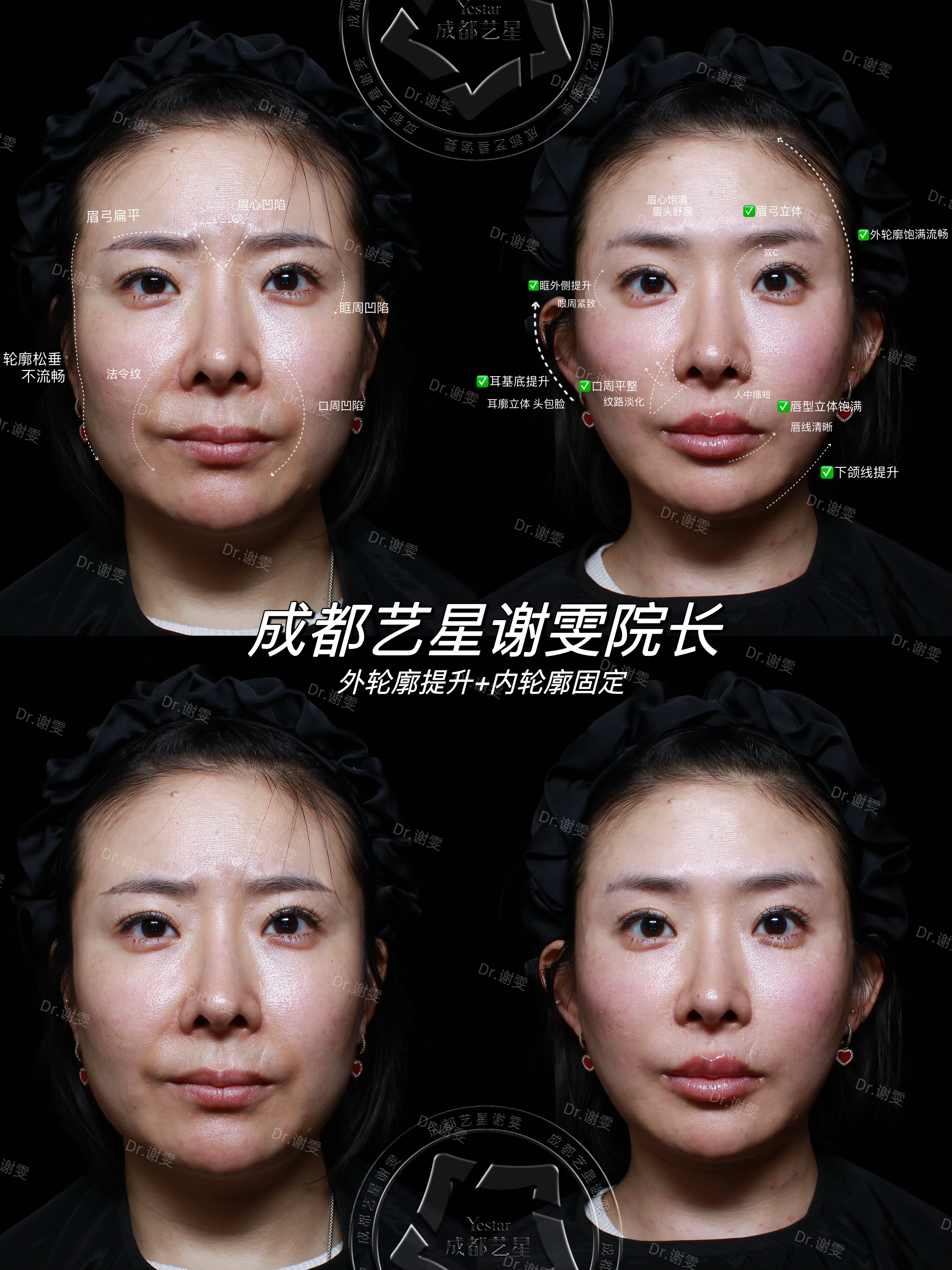 李建鋼醫(yī)生無痕筋膜提升技術亮點在哪？www.66ub.cn