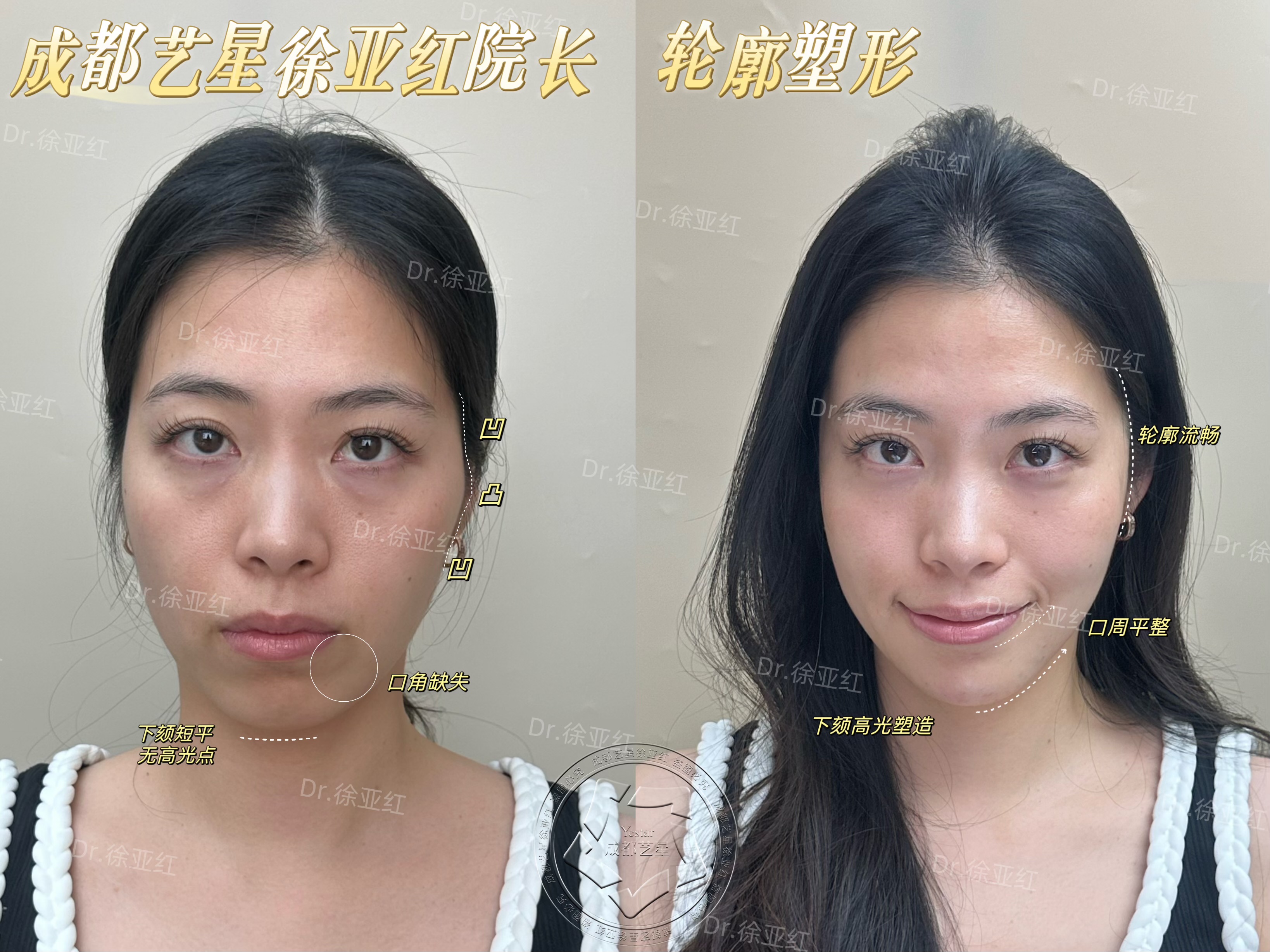 哪些因素影響無痕筋膜提升價格？