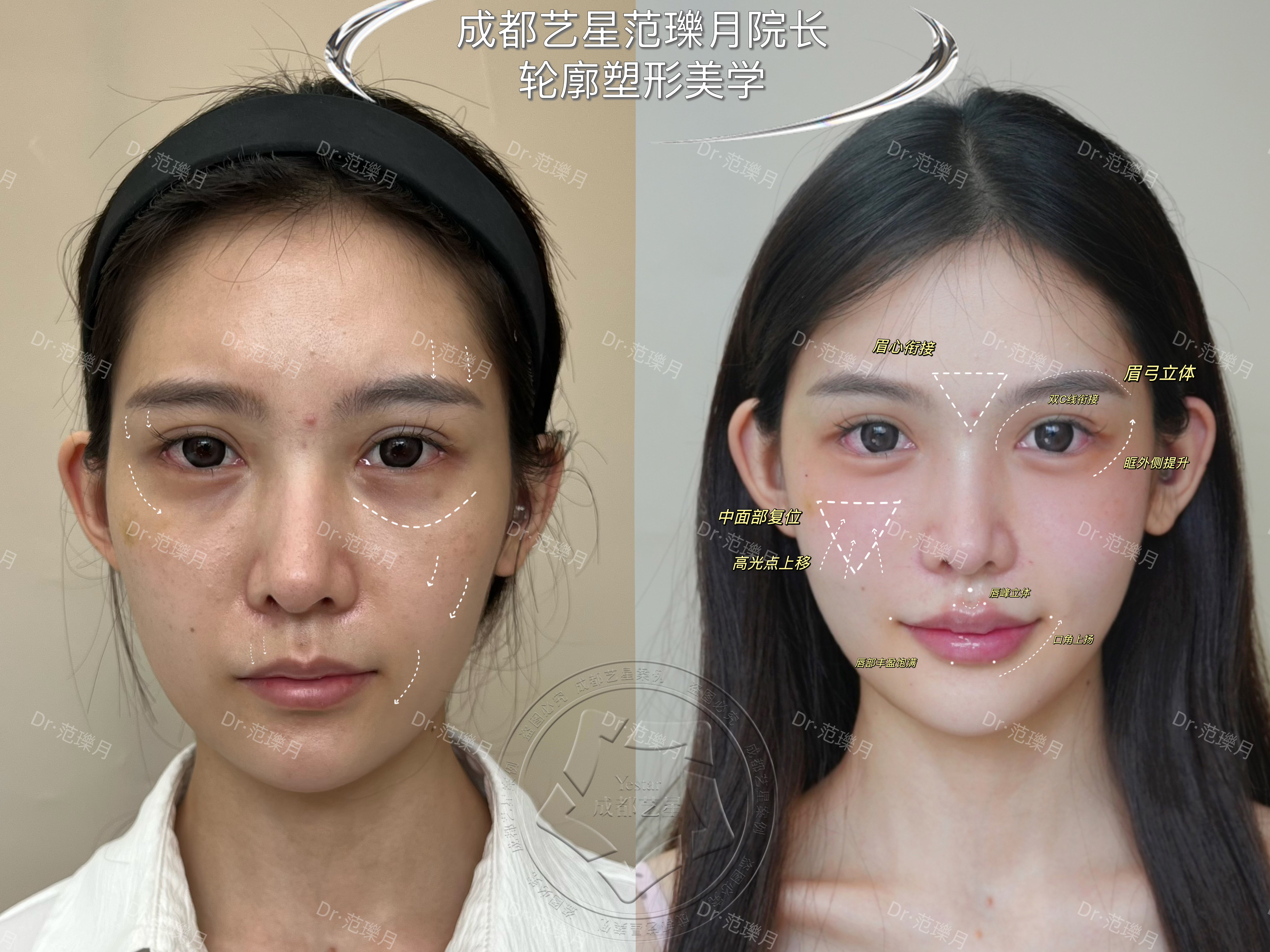 如何選擇適宜的無痕筋膜提升方案？