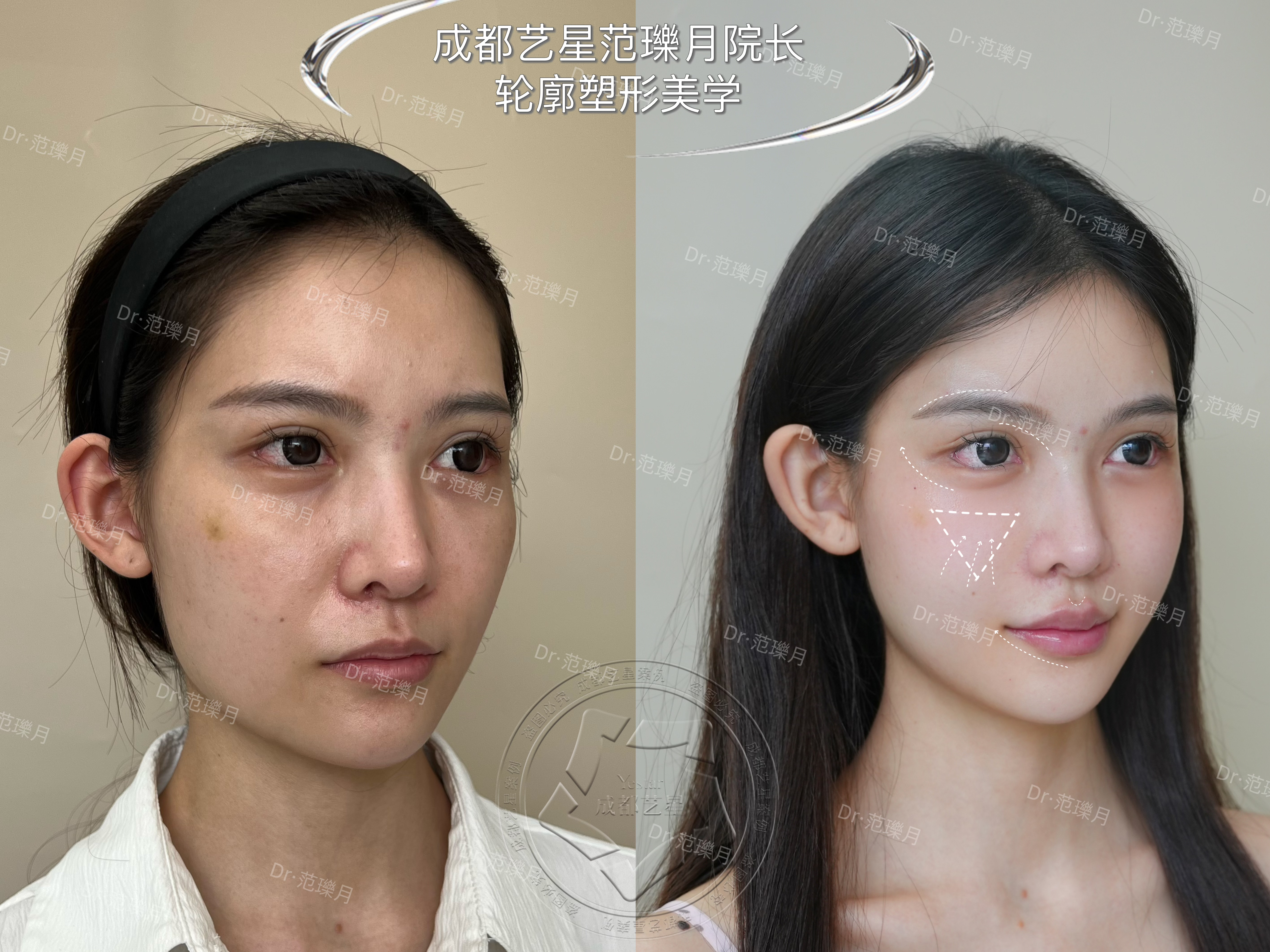 術后成效與維持時間如何？