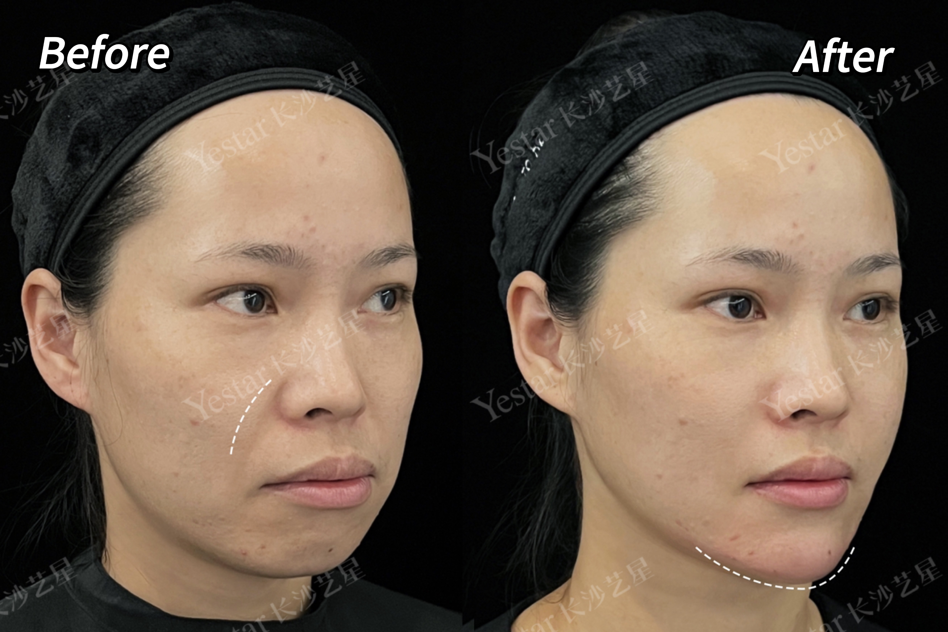 李建鋼筋膜提升與其他面部提升方法相比有什么不同？