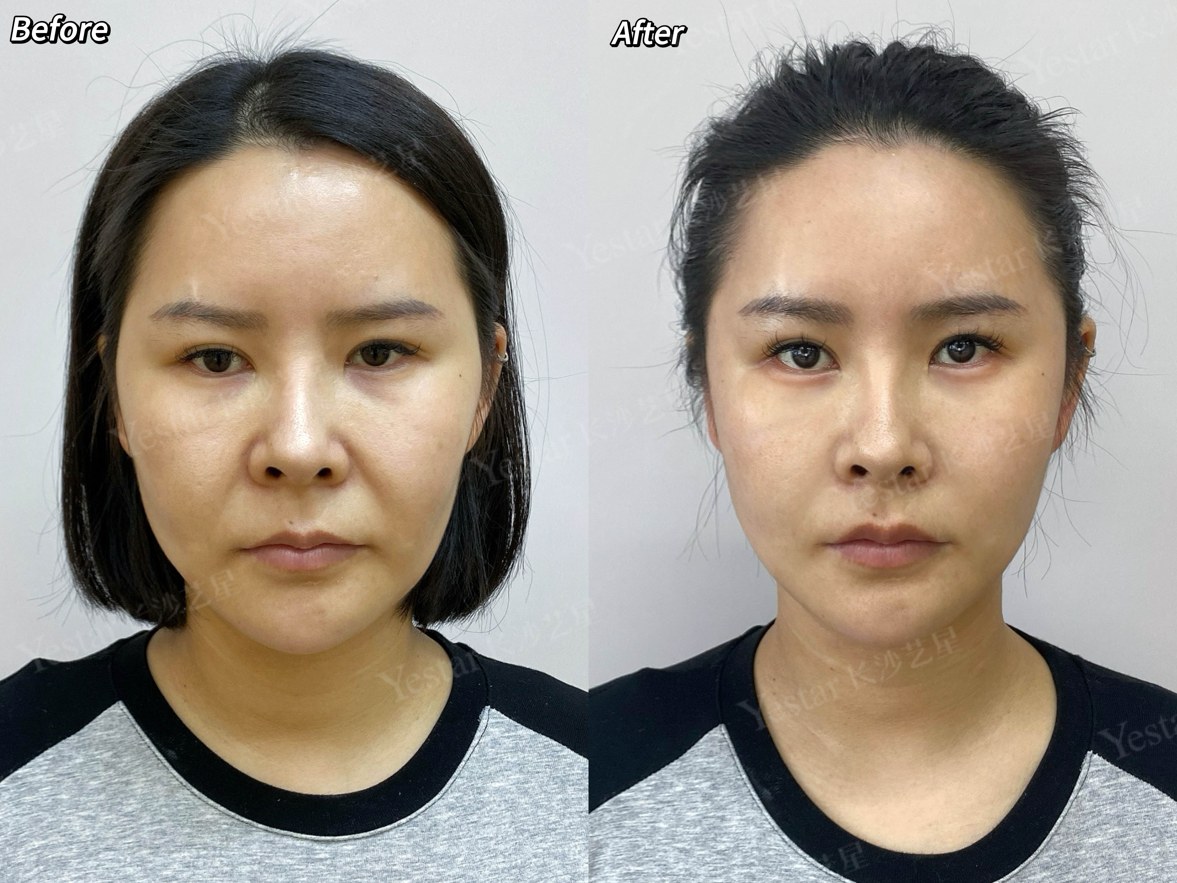 如何選擇正規(guī)的機(jī)構(gòu)和醫(yī)生進(jìn)行李建鋼筋膜提升？