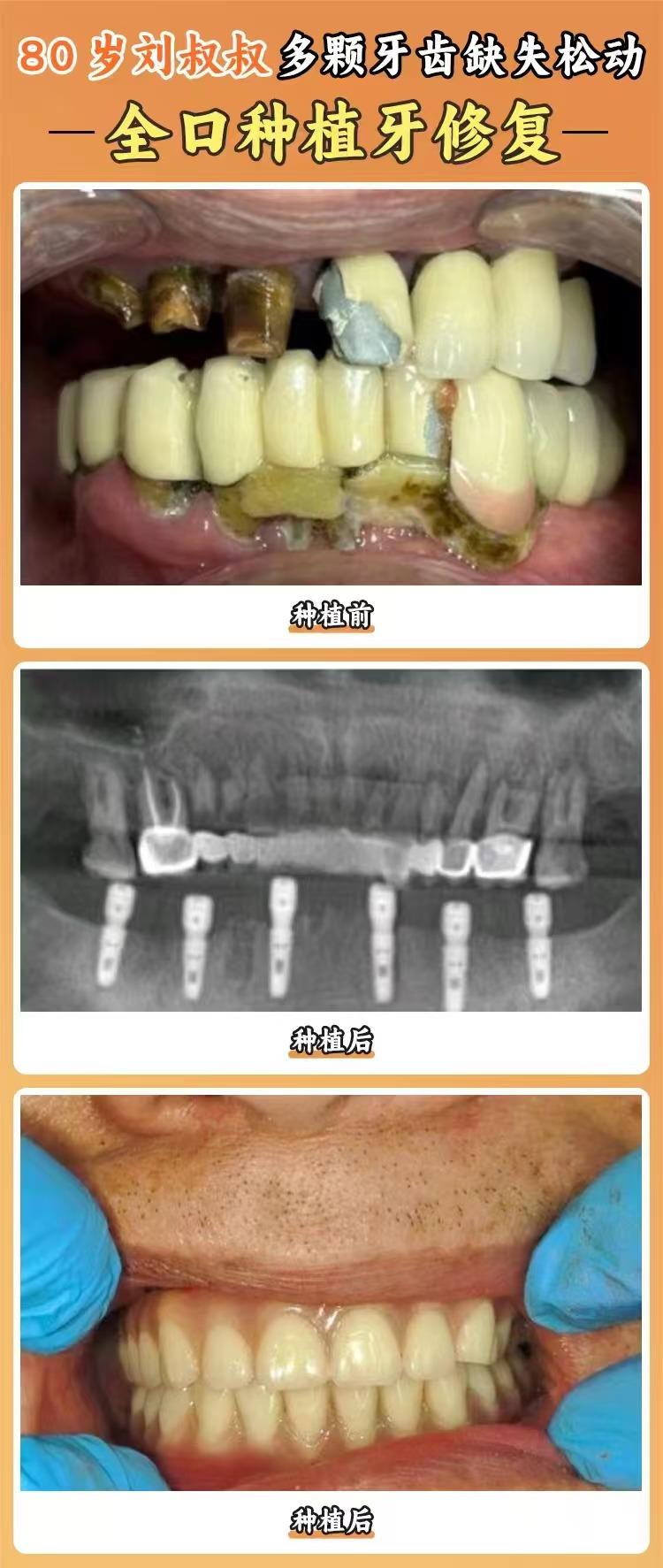 焦作植得口腔其他種植牙品牌及價(jià)格如何？