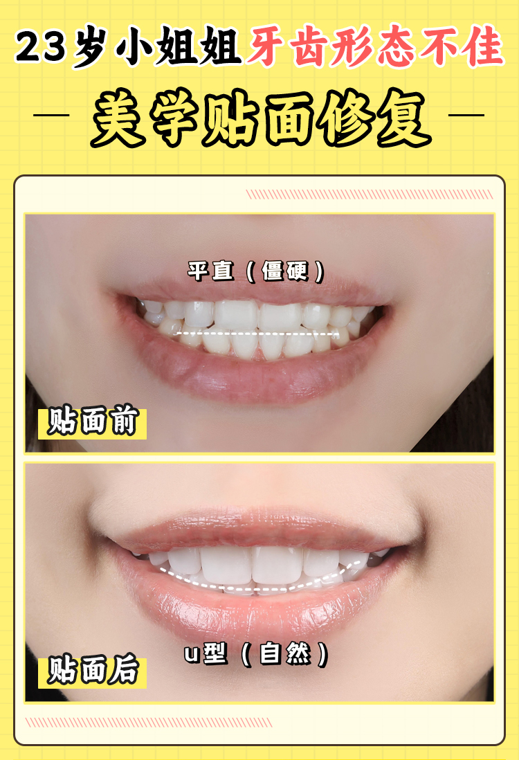 江蘇徐州牙貼面收費(fèi)標(biāo)準(zhǔn)大揭秘，瑞士E - max鑄瓷貼面1980元起！ 