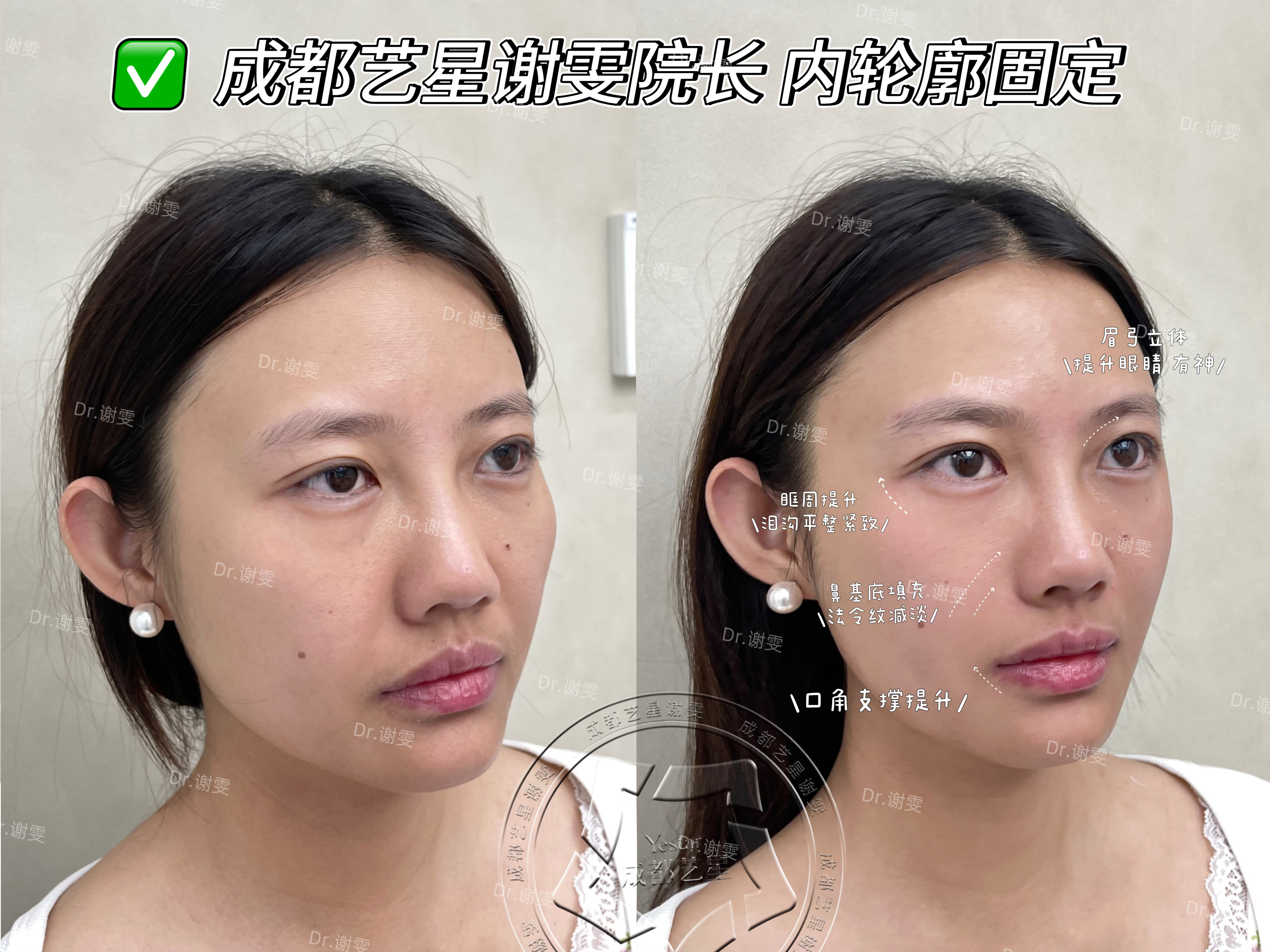 李建鋼筋膜提升的適應(yīng)人群有哪些？