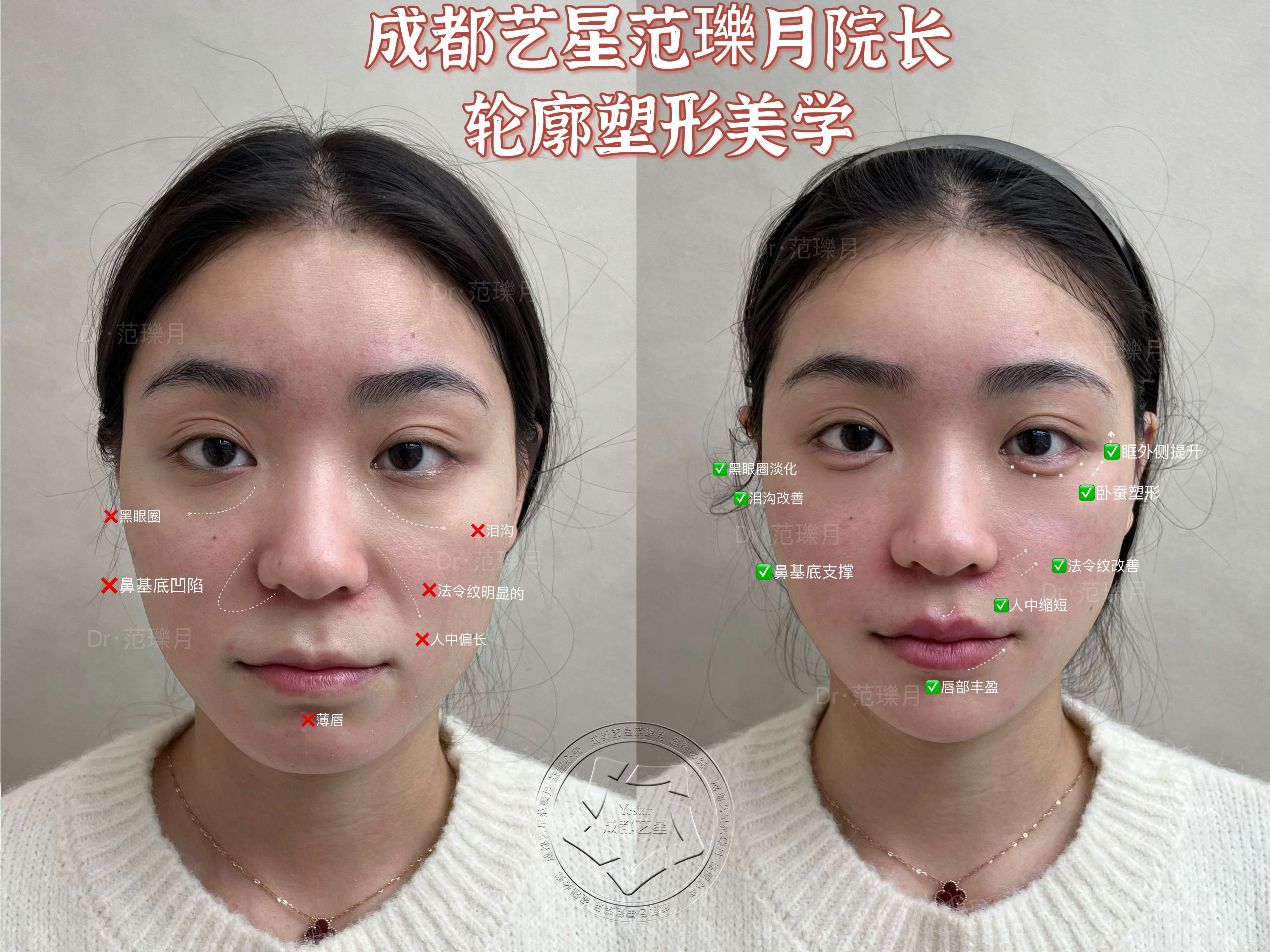 李建鋼筋膜提升的手術(shù)過程是怎樣的？