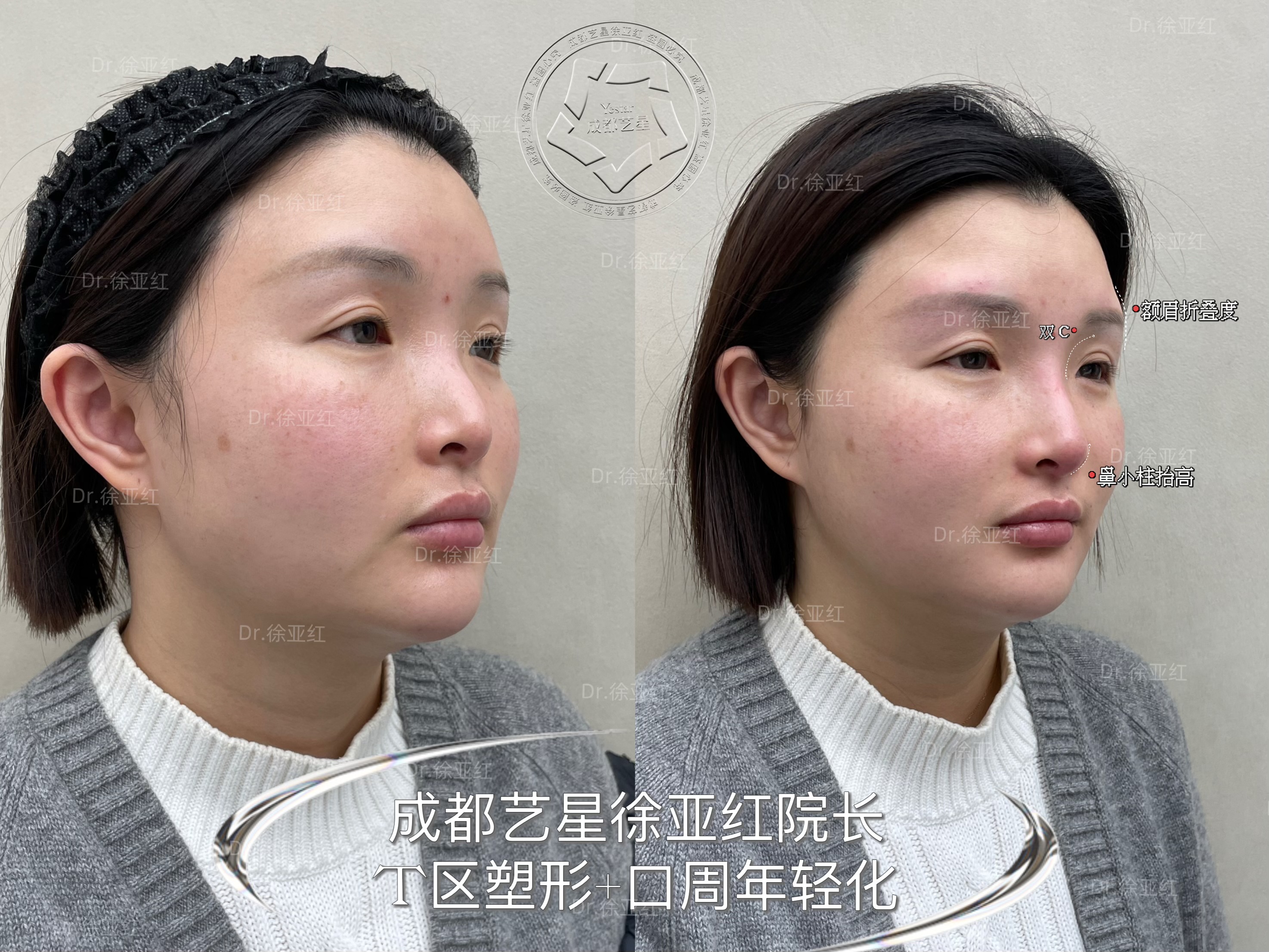 李建鋼筋膜提升術(shù)后需要注意什么？