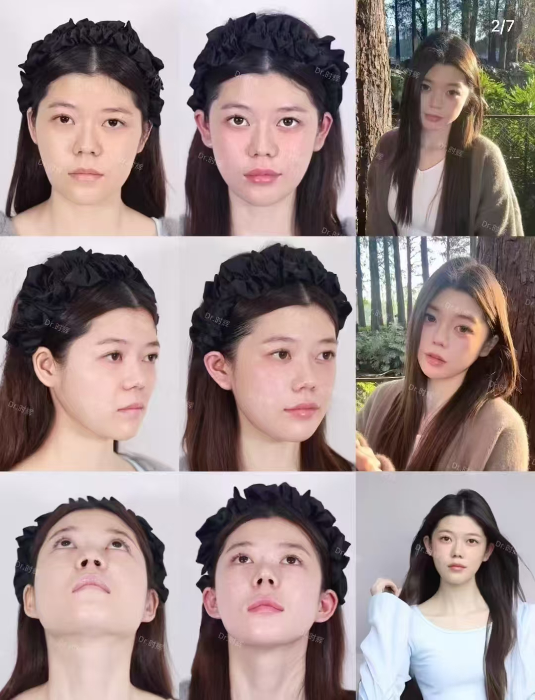 三、其他八大處拉皮手術(shù)非凡醫(yī)生介紹