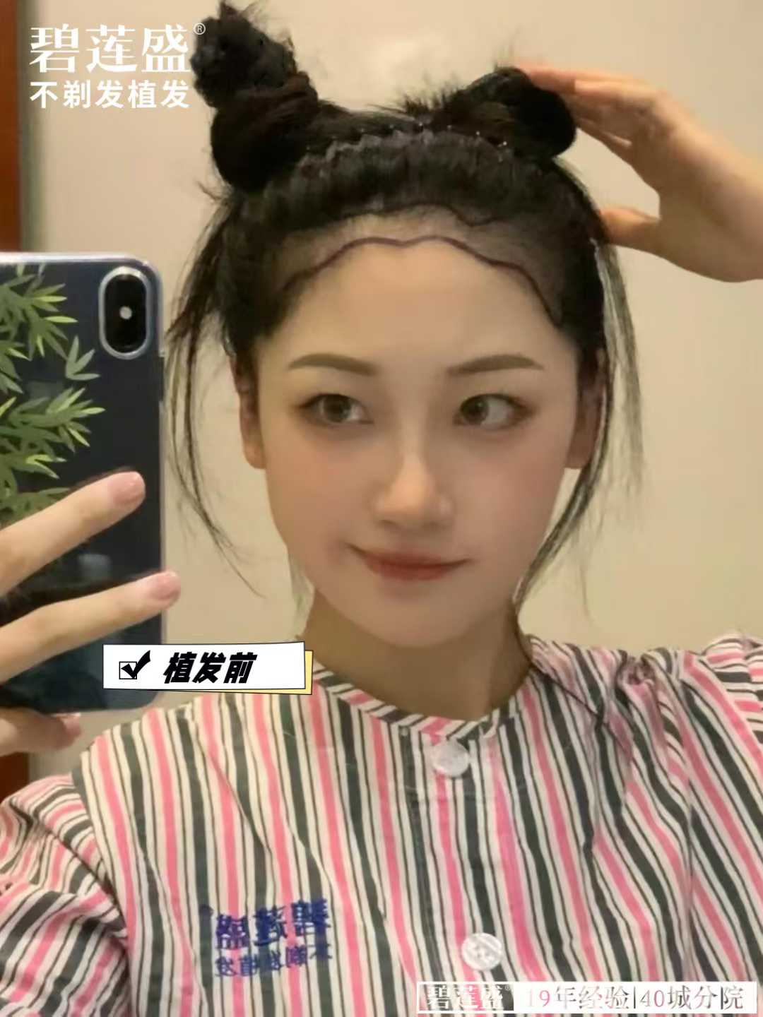 碧蓮盛3000個毛囊15000貴嗎？對比SHT12元/BHT18元/AFHT30元收費(fèi)，這價(jià)格太劃算！