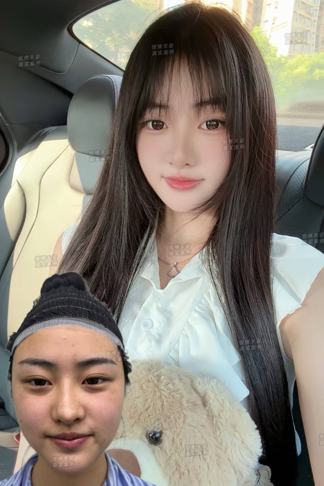 影響2026成都植發(fā)價格的因素