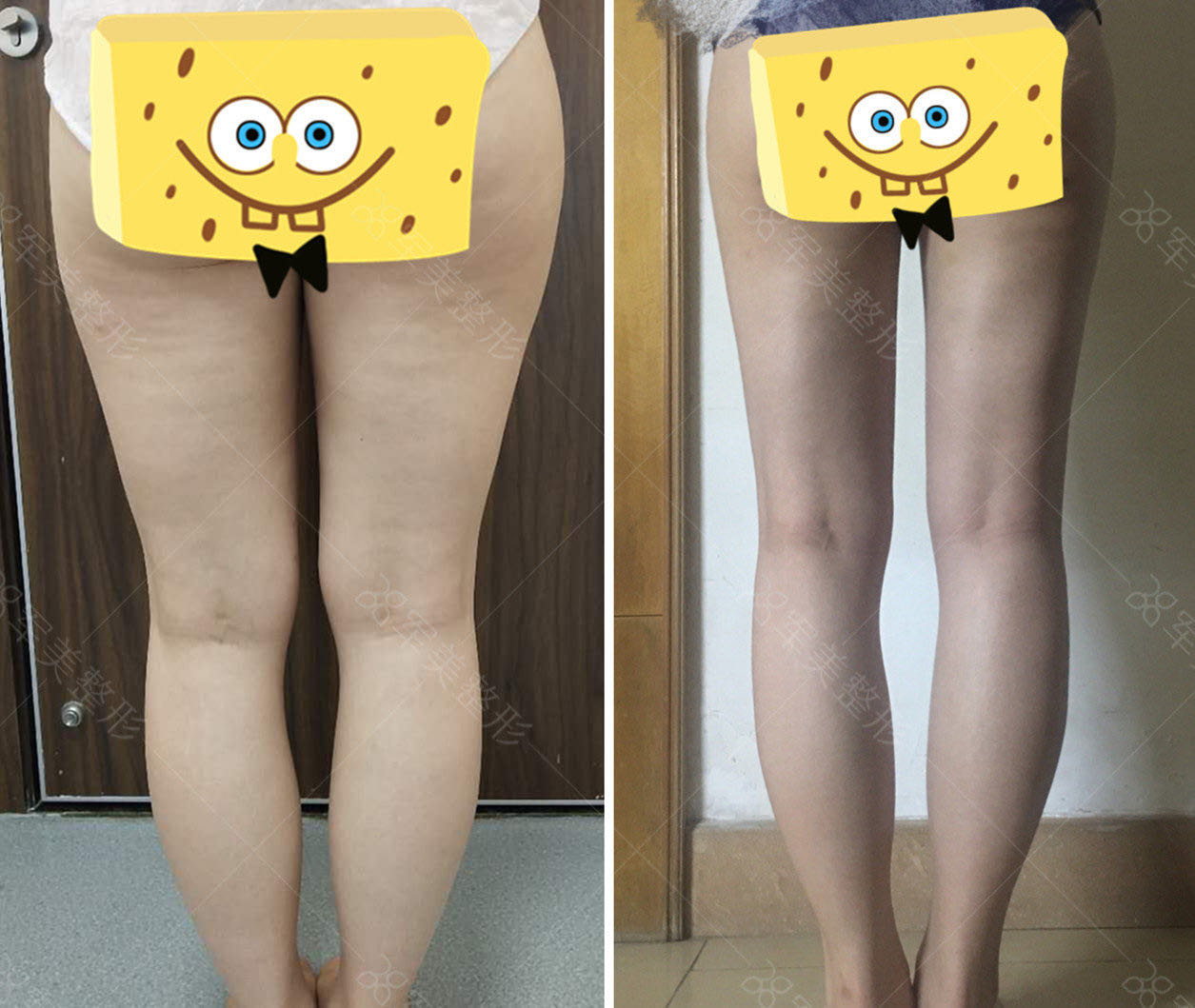 超美塑可以做臉嗎？醫(yī)院實(shí)例分享