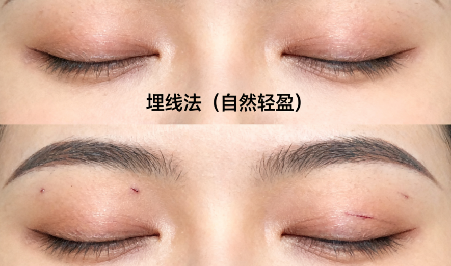 李建鋼筋膜提升價格表公布后，消費者該如何選擇？