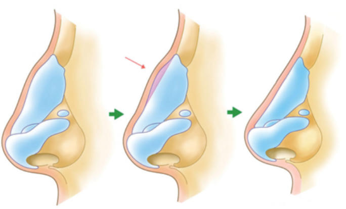 郭世偉鼻整形實(shí)例