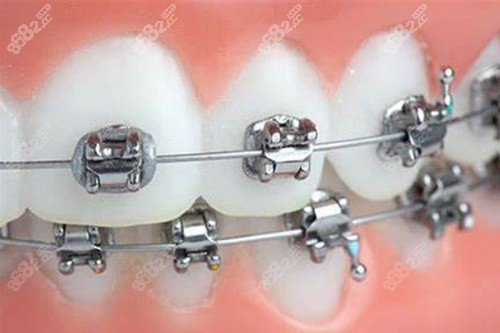 金屬牙齒矯正