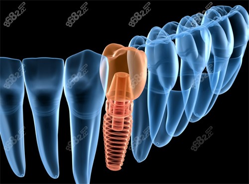 深圳上沙種植牙哪家好？格倫菲爾|美奧|登特種牙價(jià)格實(shí)惠技術(shù)好附參考表