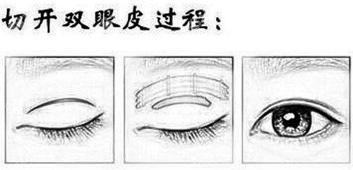 切開(kāi)雙眼皮