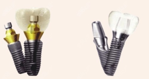 不同材質(zhì)的種植牙