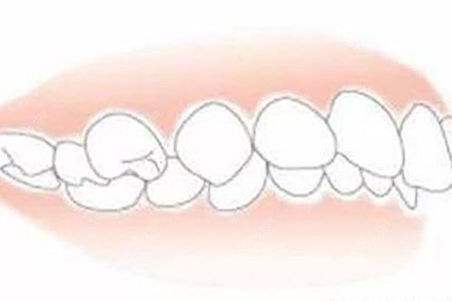 需要牙齒矯正的狀態(tài)示意圖.jpeg