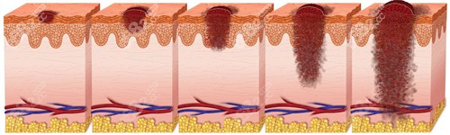 不同深度的疤痕