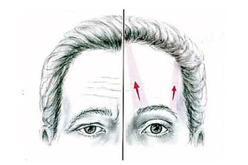 侯典舉醫(yī)生雙眼皮修復(fù)咋樣？30年經(jīng)驗+分層松解技術(shù)減張縫合淡疤痕
