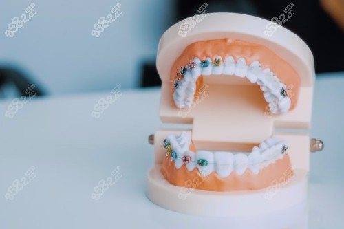 深圳上沙牙齒矯正多少錢？金屬6800起隱形1.38w+含多品牌矯正器價(jià)格大揭秘