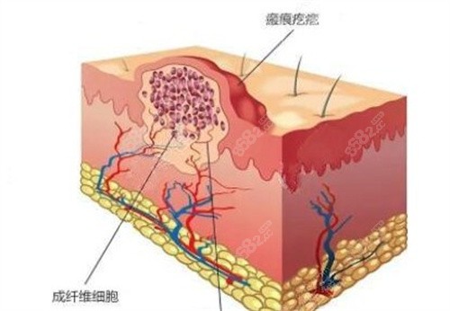 舒茂國醫(yī)生去疤痕怎么樣？心形皮下縫合+多維度治療20余年0差評附價格表
