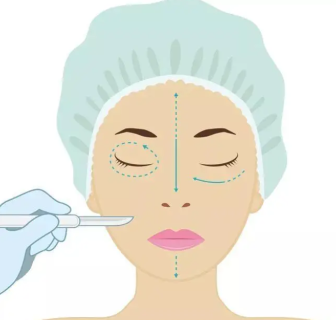 趙延勇醫(yī)生的面中下部拉皮手術(shù)