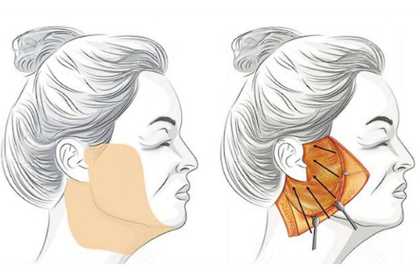 想知道趙延勇和畢洪森哪個(gè)除皺療效好？看這3位患者真實(shí)反饋，趙延勇額頭除皺滿意度高達(dá)95%