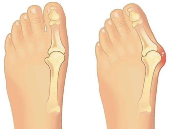 孫衛(wèi)東拇外翻復(fù)發(fā)率高嗎