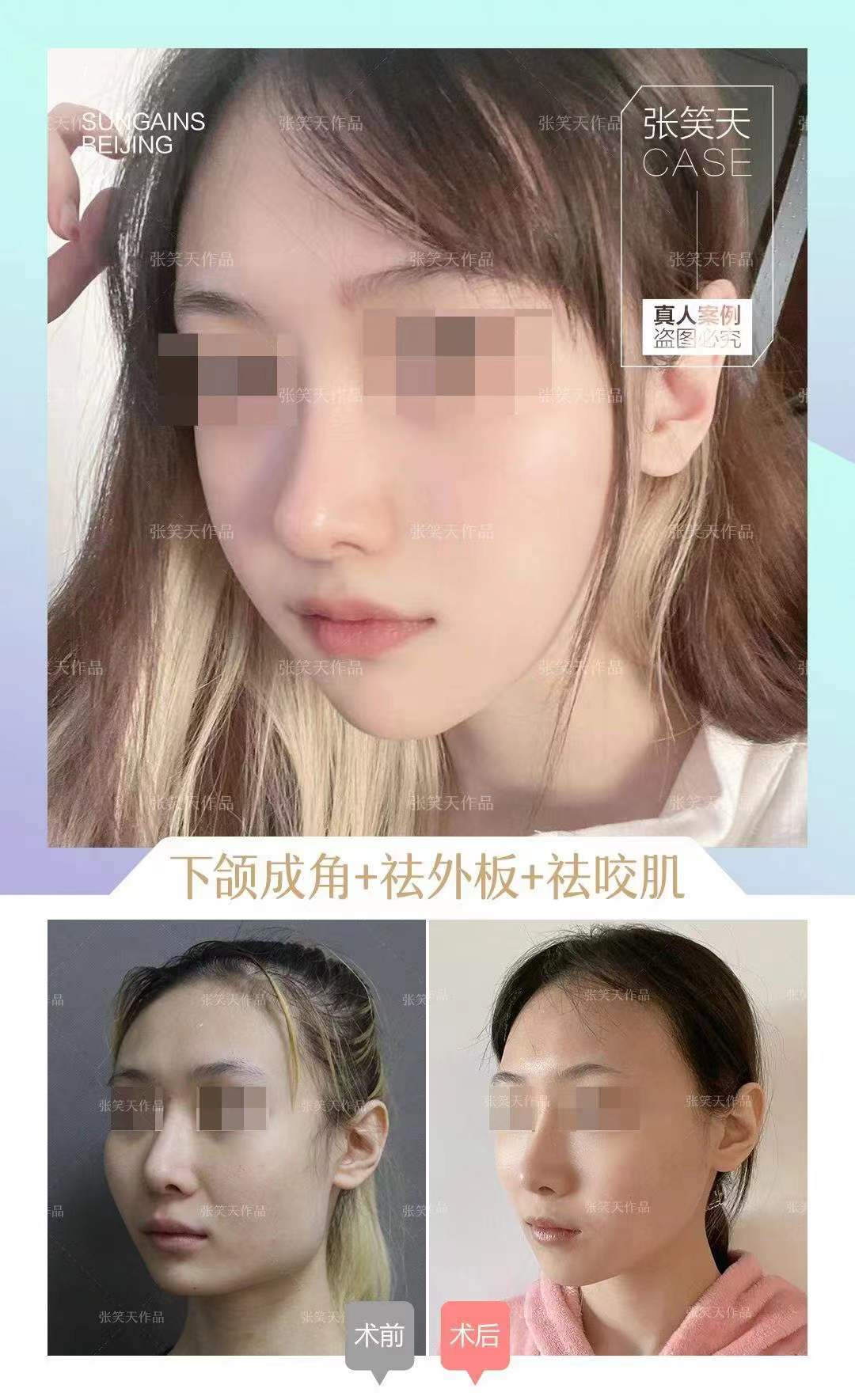 六、選擇柳超醫(yī)生磨骨的注意事項