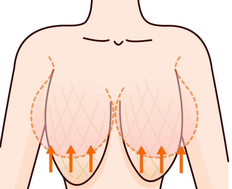 南京朱淼醫(yī)生縮胸的技術(shù)怎么樣