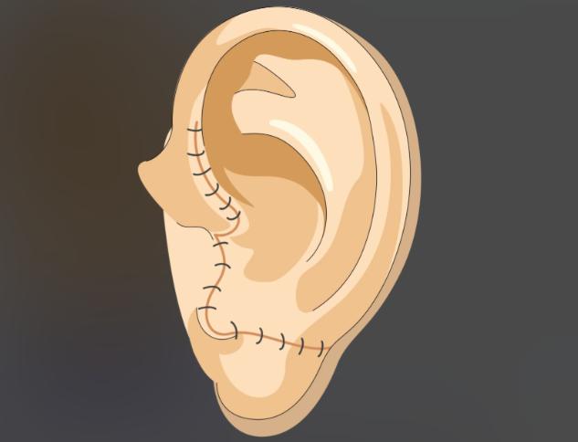 張正文小耳畸形真人實(shí)例分享