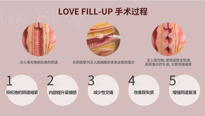 信所愛(ài)女性醫(yī)院私密整形項(xiàng)目注意事項(xiàng)