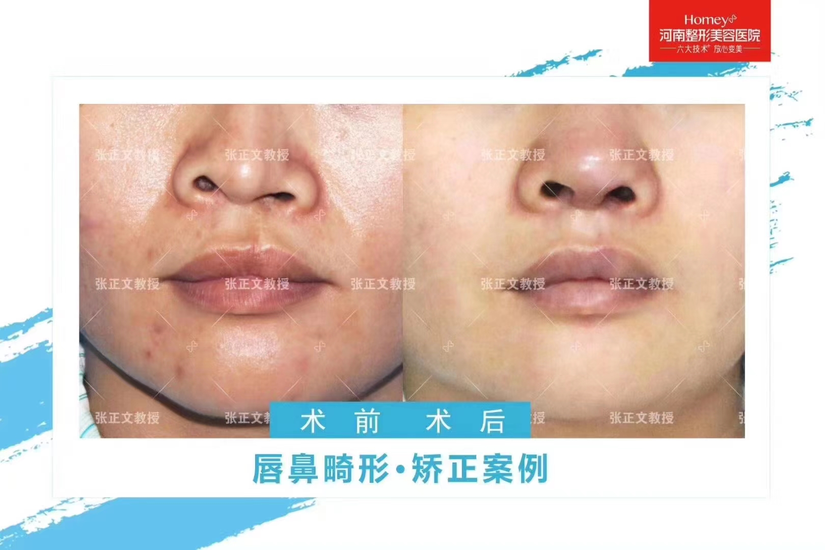 如何選擇適合自己的提臀手術(shù)方案