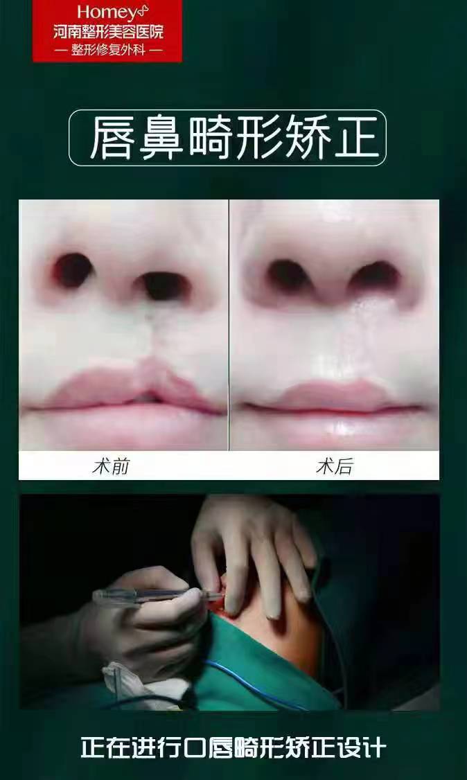 提臀手術(shù)的優(yōu)勢和成效