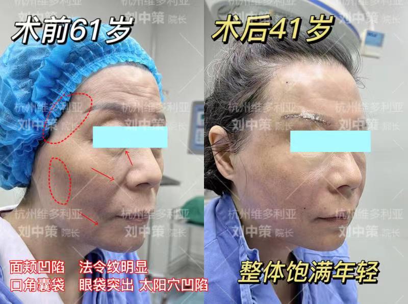 张路面部提升三件套多少钱：适合人群及注意事项