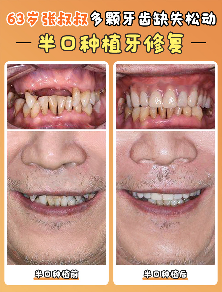 南京美奧口腔診所種植牙收費(fèi)還受哪些因素影響？