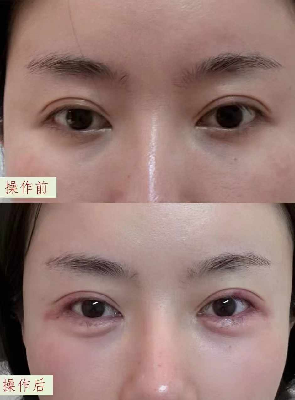 张路面部提升三件套多少钱：价格构成因素