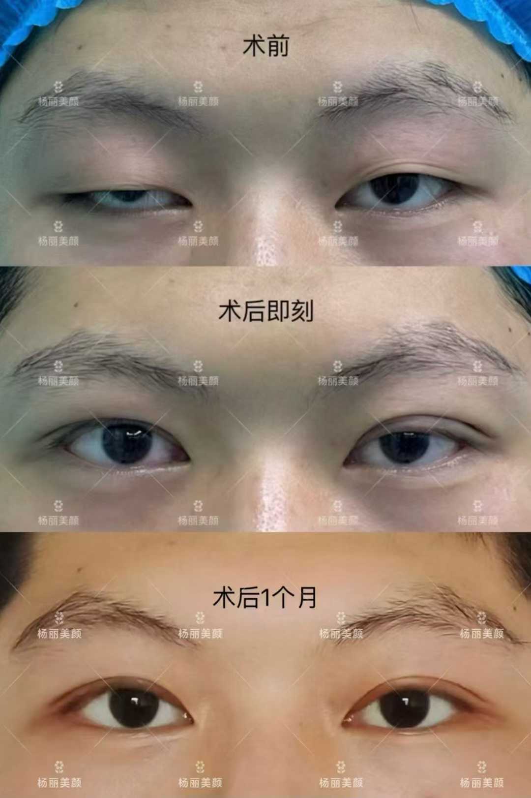 鄭州麗天羅明生抽脂的價格是否合理？