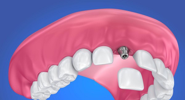 指定12家種牙醫(yī)院名單有哪些