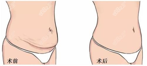 美人魚腹壁成形手術(shù)前后的區(qū)別