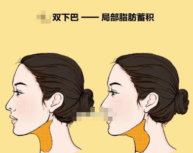 脂肪堆積量決定基礎(chǔ)費(fèi)用