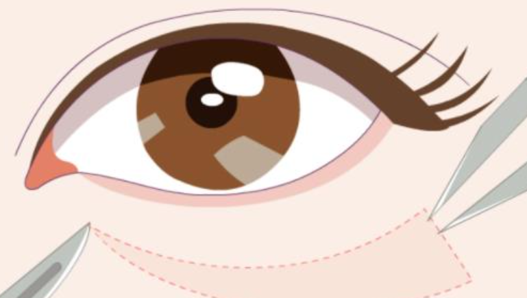 包頭祛眼袋手術技術對比與選擇建議