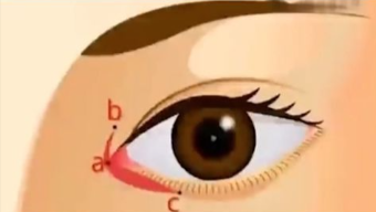 王恒和韓勛內(nèi)眼角修復(fù)哪個好？綜合分析與選擇建議