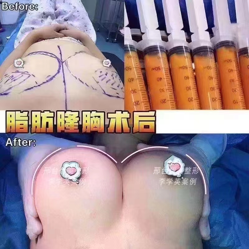 南方醫(yī)院脂肪填充技術(shù)的未來展望