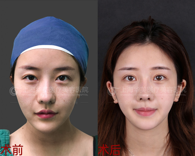 珠海艾瑞醫(yī)療美容門診部:自體脂肪豐胸的佼佼者